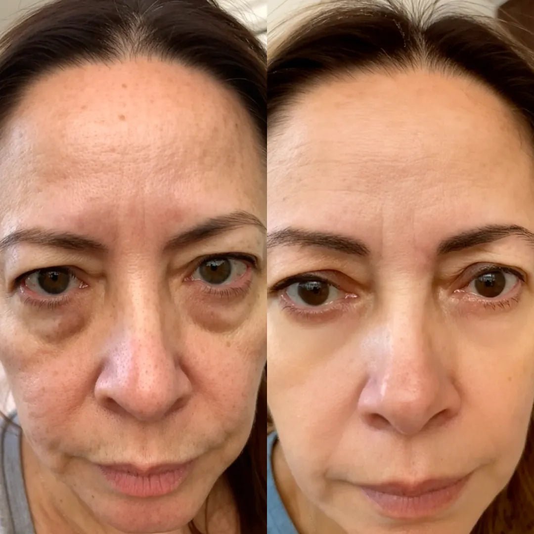 Plenia Eye 2 en 1: Terapia de Luz Roja para eliminar las bolsas de los ojos