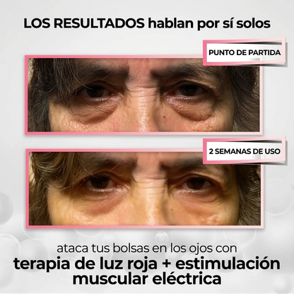 Plenia Eye 2 en 1: Terapia de Luz Roja para eliminar las bolsas de los ojos